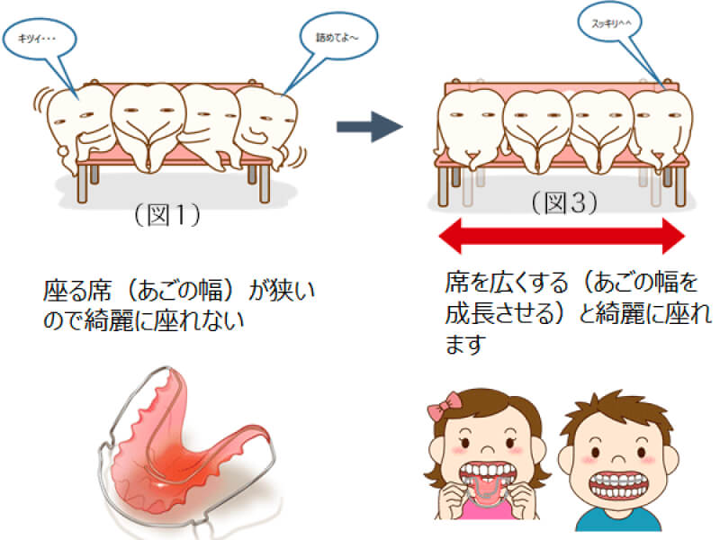 咬合育成の考え方をイラストで説明している図。座る席（あごの幅）が狭いので綺麗に座れない。席を広くする（あごの幅を成長させる）と綺麗に座れる