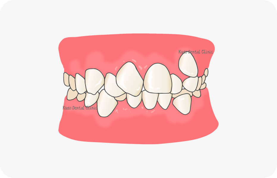 前歯のでこぼこ（叢生）のイラスト図