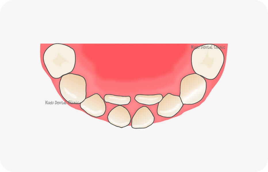 前歯の重複萌出のイラスト図