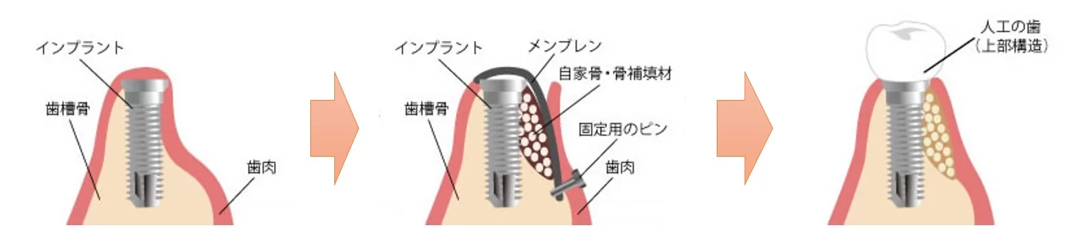 川崎の歯医者、クドウデンタルクリニックのインプラント治療
